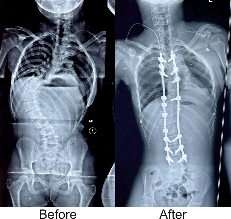 KIMS Doctors Achieve Breakthrough, Saves Young Girl’s Life with Complex Spine Surgery : Ommtv